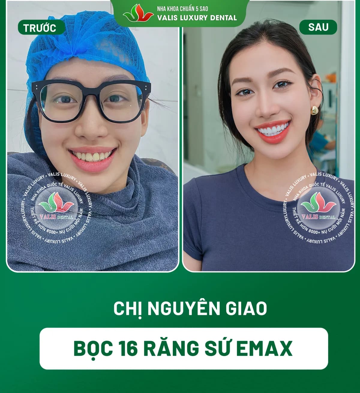 Ảnh trước và sau của Chị Nguyên Giao — Bọc 16 răng sứ Emax tại Nha khoa Valis Luxury