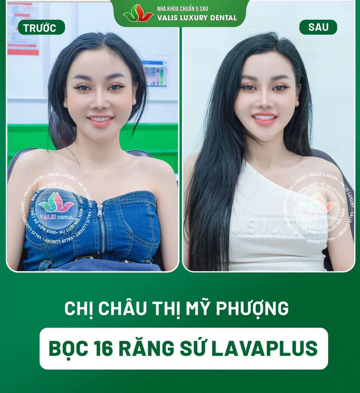 Ảnh trước và sau của Chị Châu Thị Mỹ Phượng — Bọc 16 răng sứ LavaPlus tại Nha khoa Valis Luxury