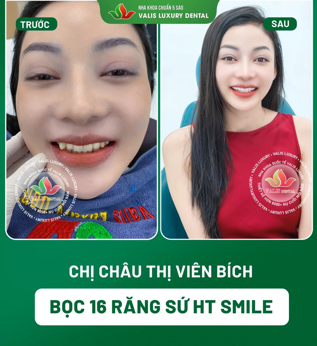 Ảnh trước và sau của Chị Châu Thị Viên Bích — Bọc 16 răng sứ HT Smile tại Nha khoa Valis Luxury