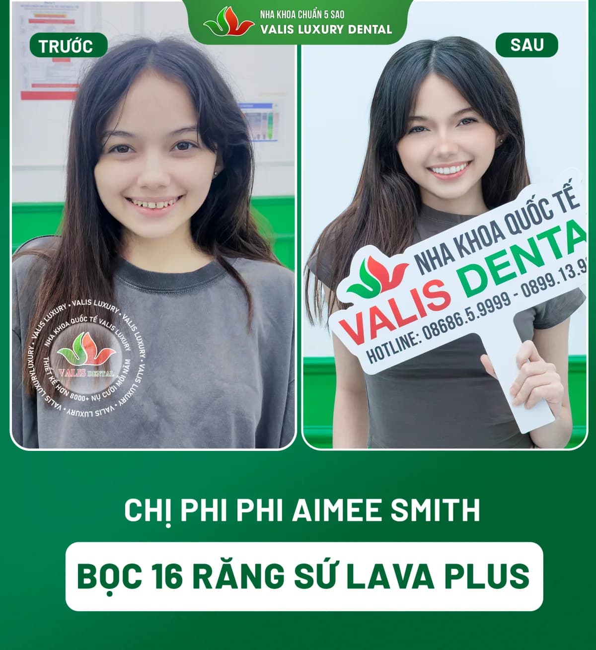 Ảnh trước và sau của Chị Phi Phi Aimee Smith — Bọc 16 răng sứ Lava Plus tại Nha khoa Valis Luxury