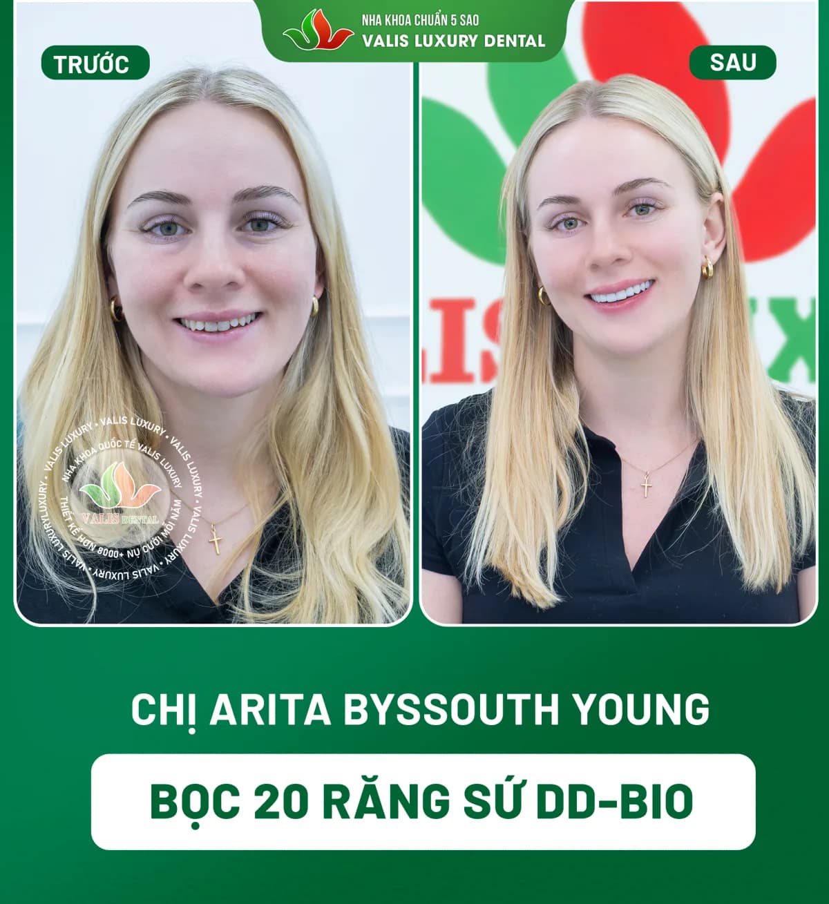 Ảnh trước và sau của Chị Arita Byssouth Young — Bọc 20 răng sứ DD-Bio tại Nha khoa Valis Luxury