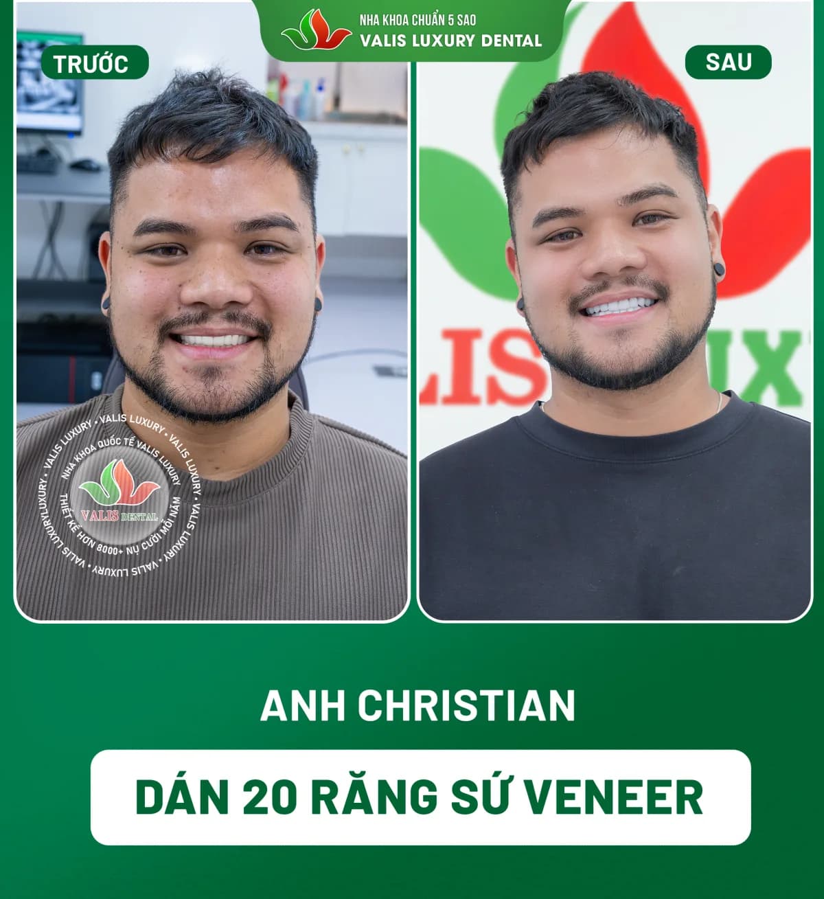 Ảnh trước và sau của Anh Christian — Dán 20 răng sứ Veneer tại Nha khoa Valis Luxury