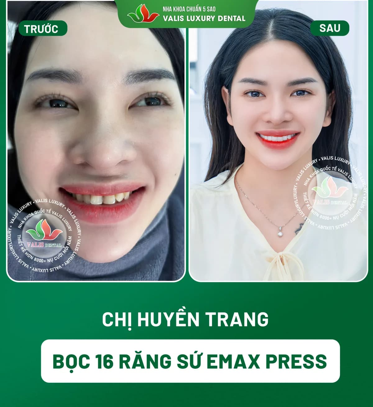 Ảnh trước và sau của Chị Huyền Trang — Bọc 16 răng sứ Emax Press tại Nha khoa Valis Luxury