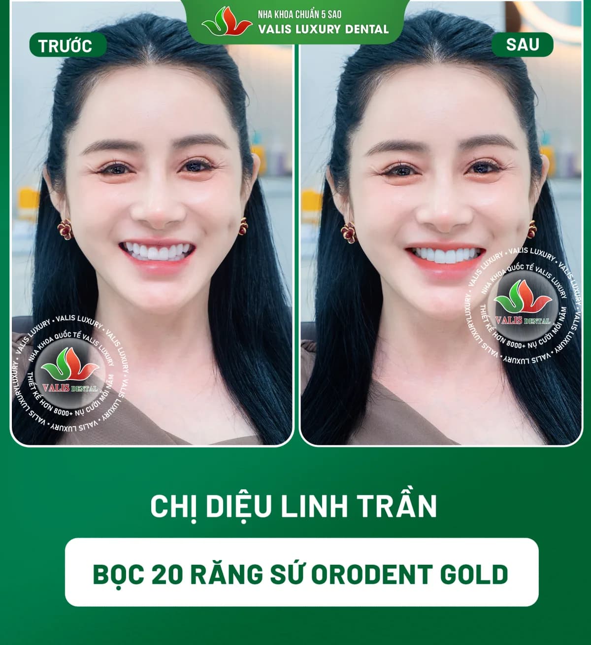 Ảnh trước và sau của Chị Diệu Linh Trần — Bọc 20 răng sứ Orodent Gold tại Nha khoa Valis Luxury
