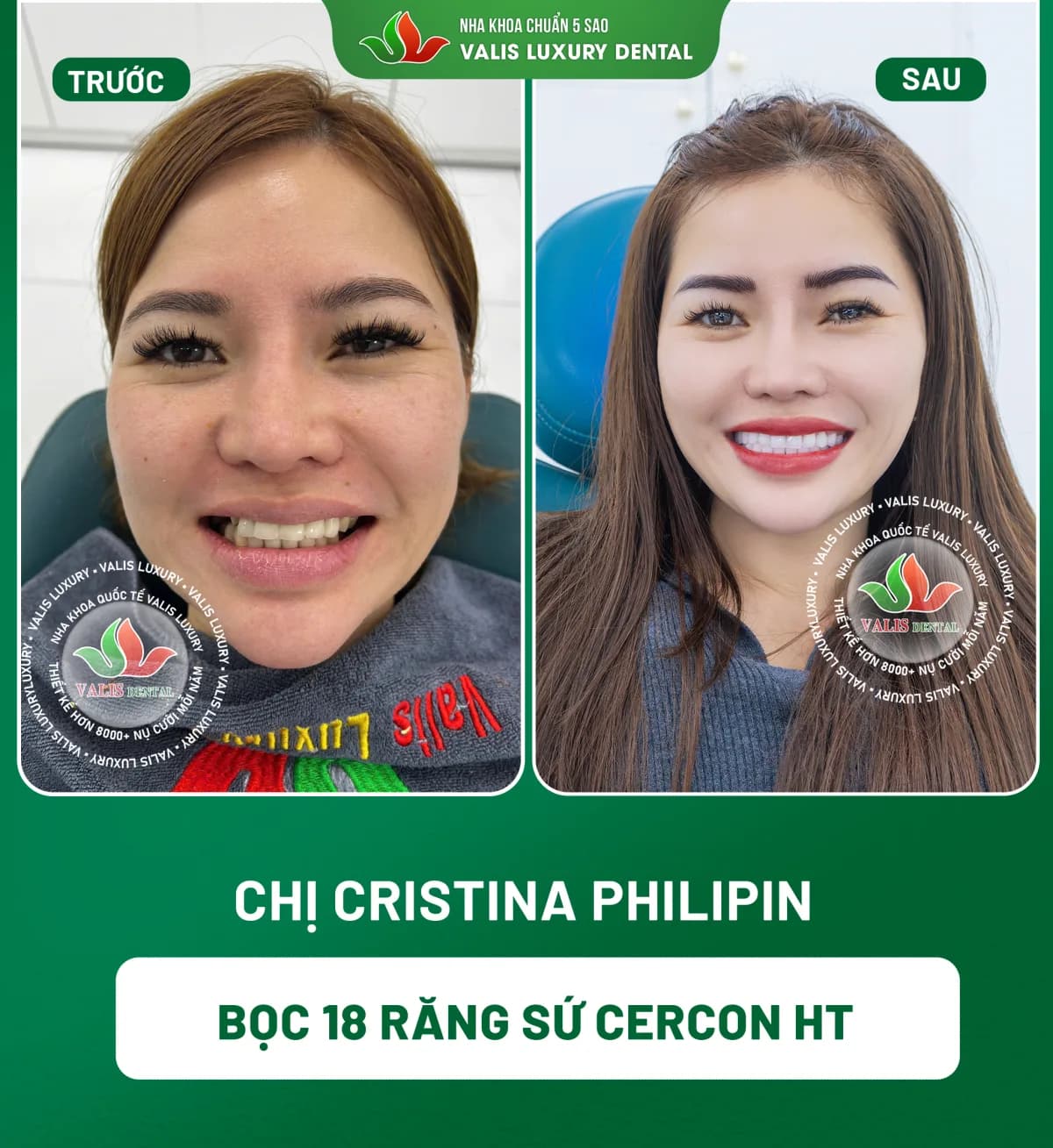 Ảnh trước và sau của Chị Cristina Philipin — Bọc 18 răng sứ Cercon HT tại Nha khoa Valis Luxury