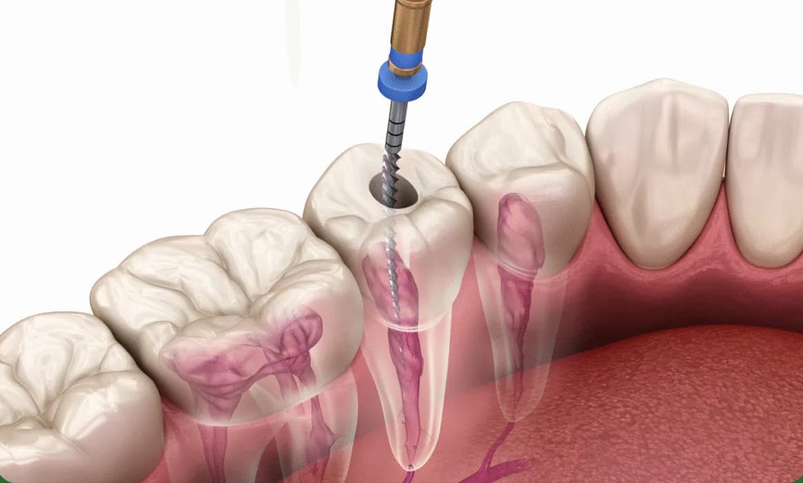 Minh hoạ dịch vụ Tẩy trắng răng thẩm mỹ