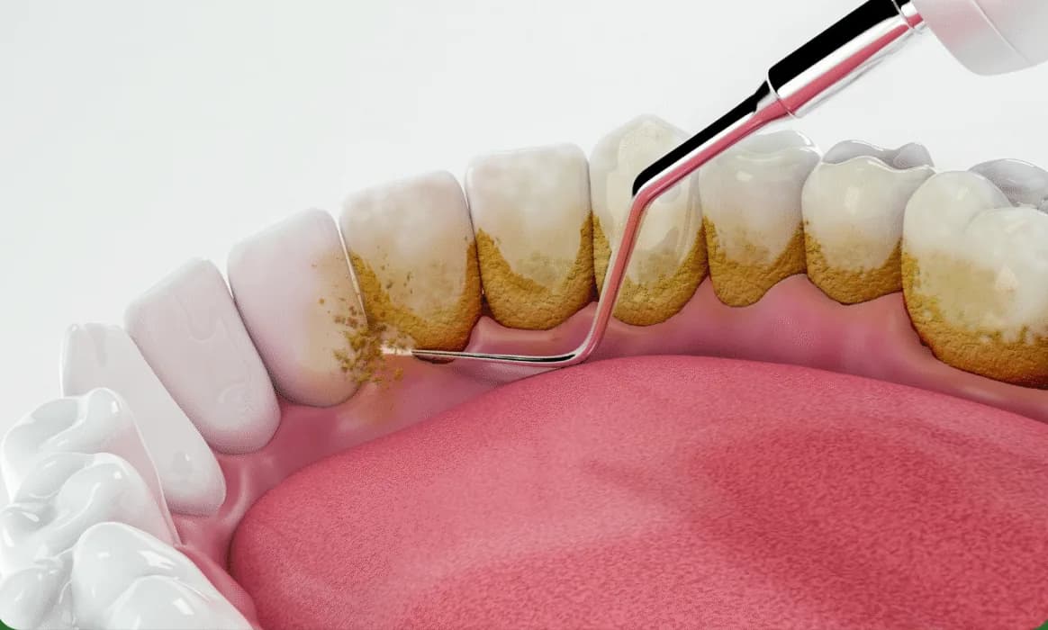 Minh hoạ dịch vụ Răng đính kim cương