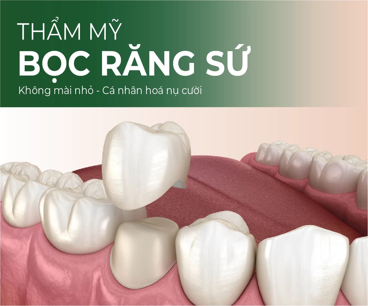 Minh hoạ Bọc răng sứ thẩm mỹ