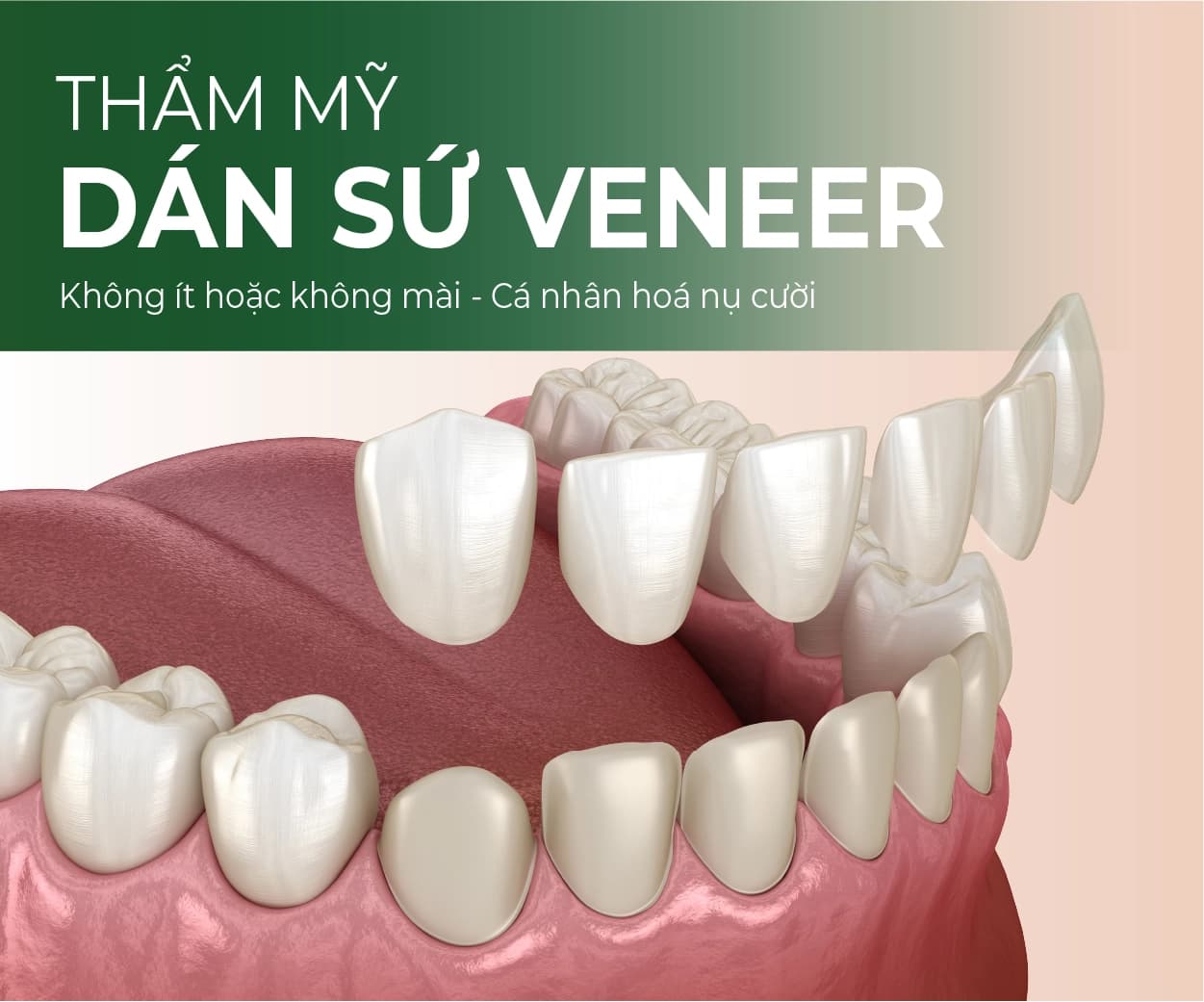 Minh hoạ Dán sứ Veneer