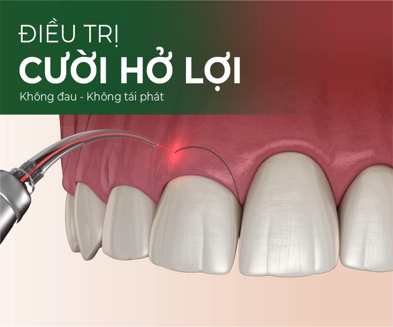 Minh hoạ dịch vụ Chữa cười hở lợi