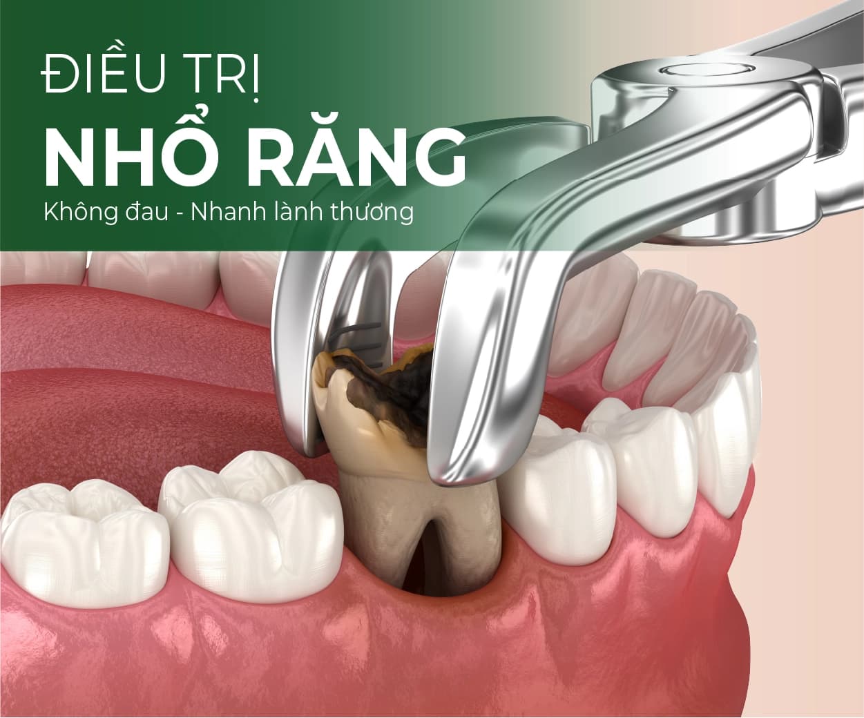 Minh hoạ dịch vụ Nhổ răng khôn