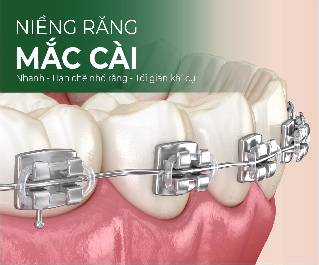Minh hoạ dịch vụ Niềng răng mắc cài
