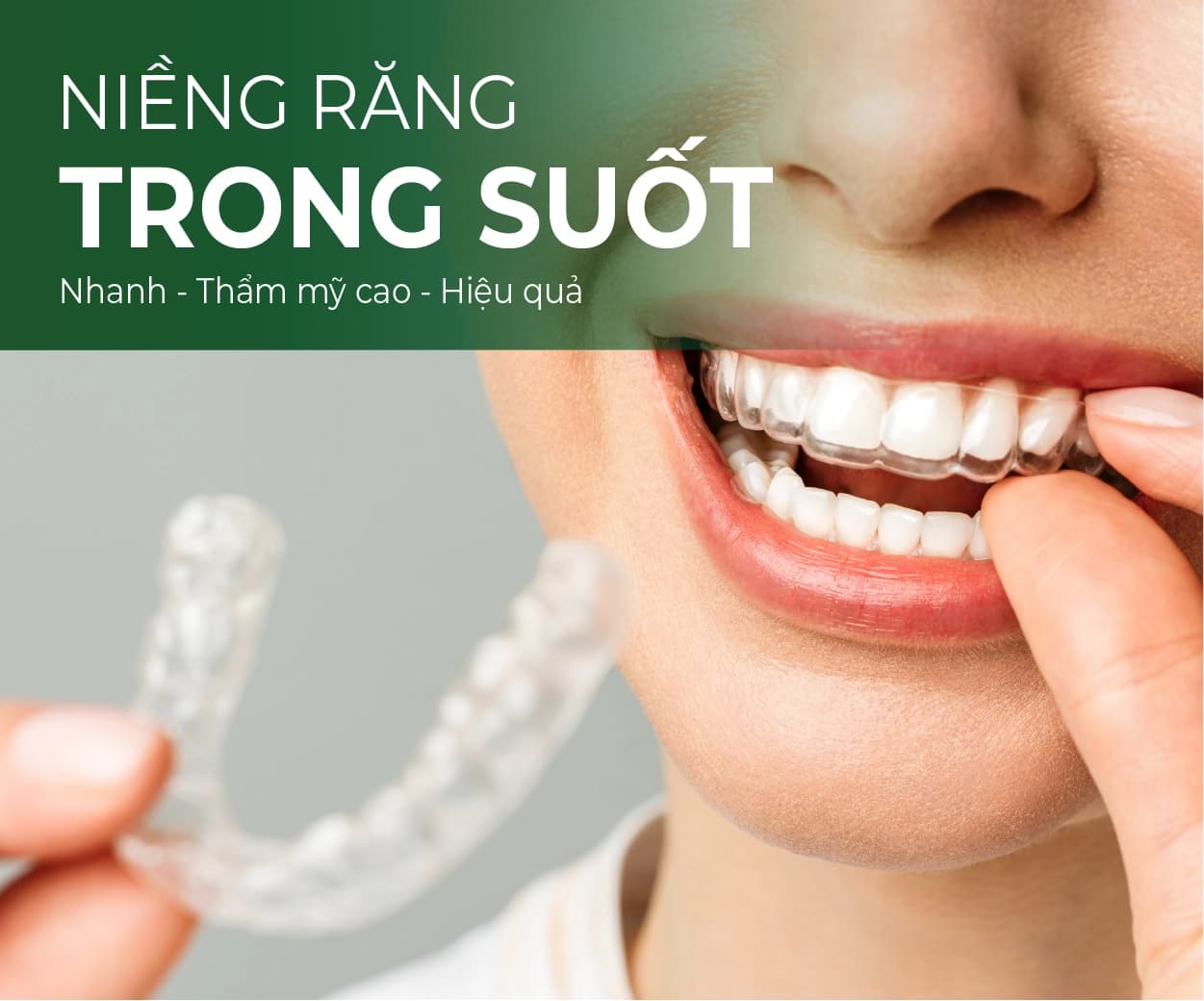 Minh hoạ Niềng răng trong suốt Invisalign