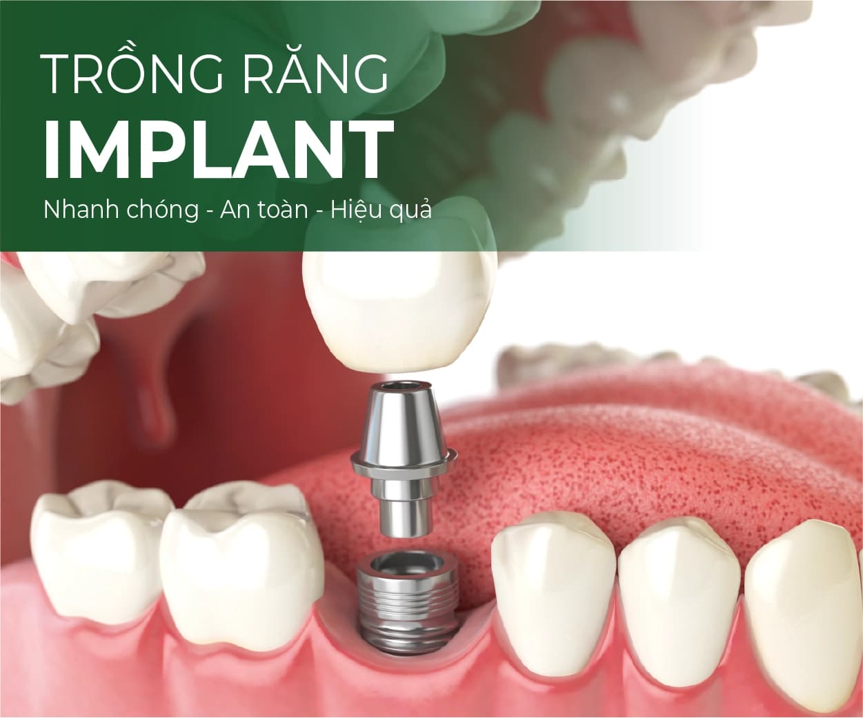 Minh hoạ Trồng răng Implant